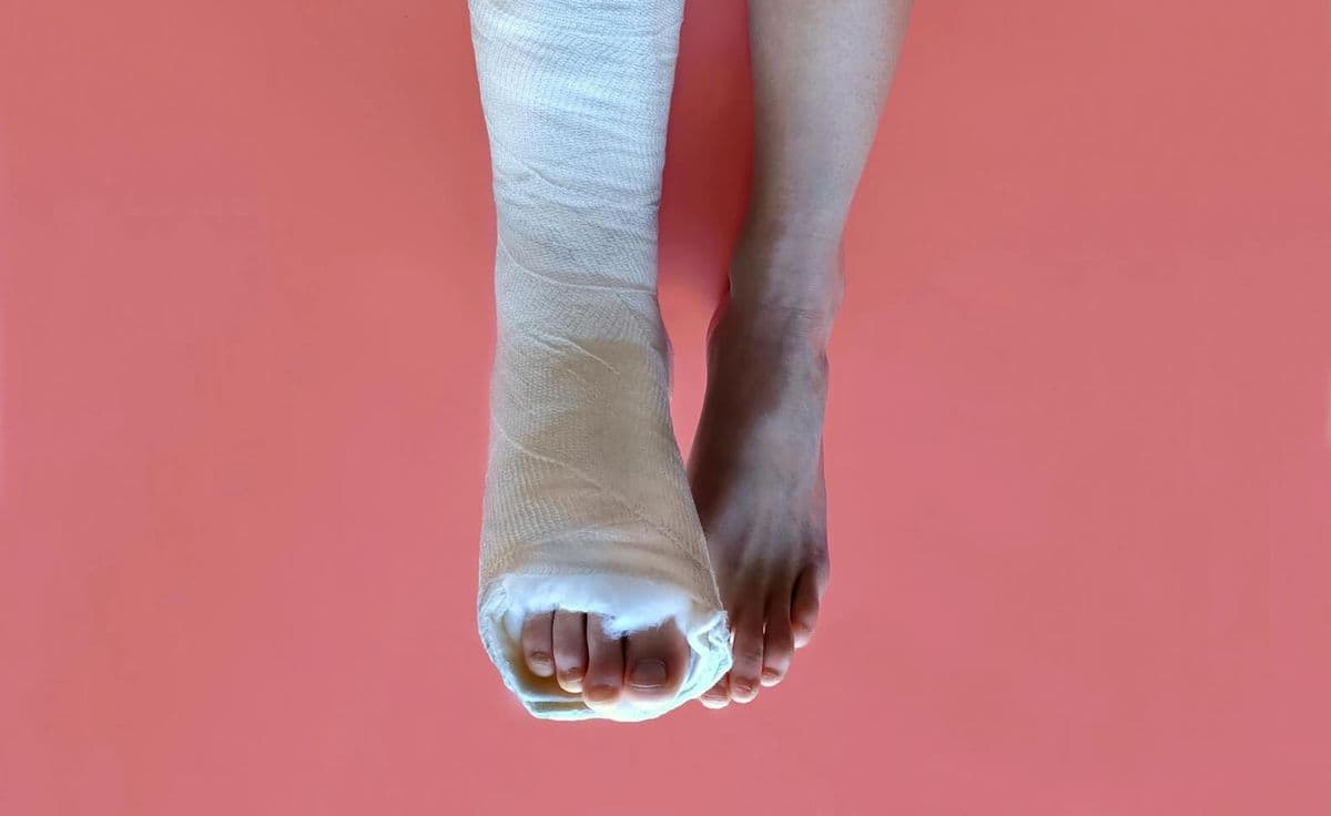 Volare con il gesso: si può? Regole, rischi e consigli pratici